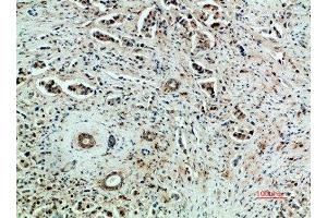 Immunohistochemical analysis of paraffin-embedded human-breast-cancer, antibody was diluted at 1:200 (VEGFR2/CD309 anticorps  (AA 1268-1341))