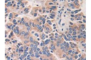 Detection of AKAP11 in Human Prostate cancer Tissue using Polyclonal Antibody to A Kinase Anchor Protein 11 (AKAP11)