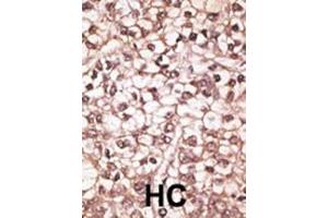 Formalin-fixed and paraffin-embedded human cancer tissue reacted with the primary antibody, which was peroxidase-conjugated to the secondary antibody, followed by AEC staining.