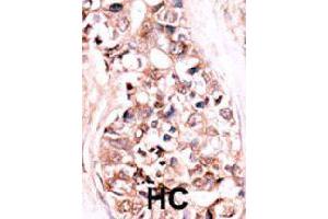 Formalin-fixed and paraffin-embedded human hepatocellular carcinoma tissue reacted with DUSP14 polyclonal antibody  , which was peroxidase-conjugated to the secondary antibody, followed by AEC staining. (DUSP14 anticorps  (N-Term))