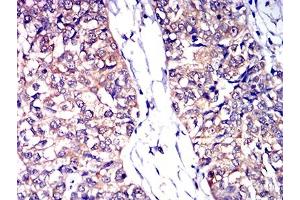 Immunohistochemical analysis of paraffin-embedded bladder cancer tissues using CD53 mouse mAb with DAB staining. (CD53 anticorps)
