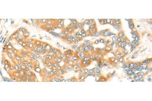 Immunohistochemistry of paraffin-embedded Human liver cancer tissue using CFHR2 Polyclonal Antibody at dilution of 1:35(x200) (CFHR2 anticorps)