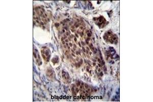 FRAT2 Antibody (C-term) (ABIN655793 and ABIN2845223) immunohistochemistry analysis in formalin fixed and paraffin embedded human bladder carcinoma followed by peroxidase conjugation of the secondary antibody and DAB staining. (FRAT2 anticorps  (C-Term))