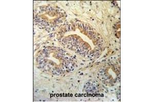 CWC15 Antibody (Center) (ABIN651004 and ABIN2840035) IHC analysis in formalin fixed and paraffin embedded prostate carcinoma followed by peroxidase conjugation of the secondary antibody and DAB staining. (CWC15 anticorps  (AA 123-152))