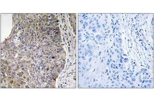 Immunohistochemistry analysis of paraffin-embedded human lung carcinoma tissue, using NEK7 Antibody. (NEK7 anticorps  (AA 101-150))