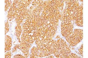 Formalin-fixed, paraffin-embedded human Renal Cell Carcinoma stained with RCC Monoclonal Antibody (SPM314). (CA9 anticorps)