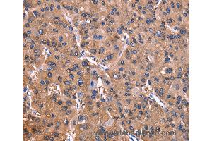 Immunohistochemistry of Human gastric cancer using ADM2 Polyclonal Antibody at dilution of 1:40