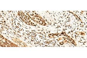 Immunohistochemistry of paraffin-embedded Human esophagus cancer tissue using METTL1 Polyclonal Antibody at dilution of 1:50(x200) (METTL1 anticorps)
