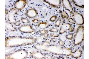 Anti- EBAG9 Picoband antibody,IHC(P) IHC(P): Human Prostatic Cancer Tissue (RCAS1 anticorps  (AA 31-213))