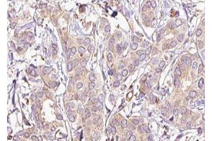 ABIN6277438 at 1/100 staining Human breast cancer tissue by IHC-P. (TPM2 anticorps  (C-Term))
