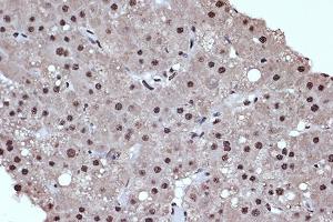 Immunohistochemistry of paraffin-embedded human liver cancer using HD Rabbit mAb (ABIN7267714) at dilution of 1:100 (40x lens).