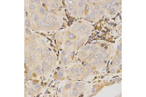 Immunohistochemistry of paraffin-embedded human liver cancer using KLK5 antibody (ABIN5971539) at dilution of 1/200 (40x lens). (Kallikrein 5 anticorps)