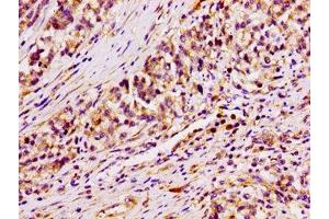 IHC image of ABIN7144779 diluted at 1:100 and staining in paraffin-embedded human colon cancer performed on a Leica BondTM system. (ARID3A anticorps  (AA 26-137))