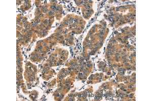 Immunohistochemistry of Human breast cancer using ARL6IP1 Polyclonal Antibody at dilution of 1:30 (ARL6IP1 anticorps)
