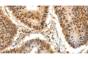 Immunohistochemistry of paraffin-embedded Human colon cancer tissue using SSB Polyclonal Antibody at dilution 1:50 (SSB anticorps)