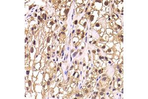 Immunohistochemistry of paraffin-embedded human kidney cancer using TCEB3 antibody. (TCEB3 anticorps)