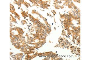 Immunohistochemistry of Human gastric cancer using RARRES1 Polyclonal Antibody at dilution of 1:60 (RARRES1 anticorps)