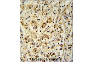 SMAGP Antibody immunohistochemistry analysis in formalin fixed and paraffin embedded human breast carcinoma followed by peroxidase conjugation of the secondary antibody and DAB staining. (SMAGP anticorps  (AA 46-75))