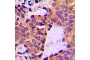 Immunohistochemical analysis of Cortactin (pY466) staining in human breast cancer formalin fixed paraffin embedded tissue section.