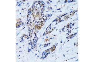 Immunohistochemistry of paraffin-embedded human breast cancer using IMPA1 antibody (ABIN2563424) at dilution of 1:100 (40x lens). (IMPA1 anticorps)