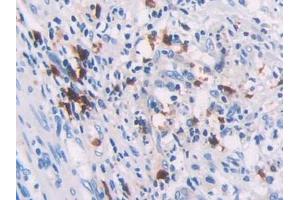 DAB staining on IHC-P; Samples: Human Colorectal cancer Tissue