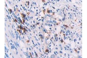 DAB staining on IHC-P; Samples: Human Colorectal cancer Tissue (RHOQ anticorps  (AA 1-202))