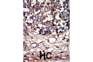 Formalin-fixed and paraffin-embedded human hepatocellular carcinoma tissue reacted with NEK9 polyclonal antibody  , which was peroxidase-conjugated to the secondary antibody, followed by AEC staining. (NEK9 anticorps  (C-Term))