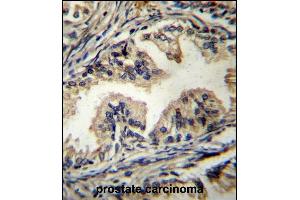 STBP Antibody (C-term) (ABIN656627 and ABIN2845873) immunohistochemistry analysis in formalin fixed and paraffin embedded human prostate carcinoma followed by peroxidase conjugation of the secondary antibody and DAB staining. (STAMBP anticorps  (C-Term))