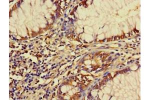 Immunohistochemistry of paraffin-embedded human colon cancer using ABIN7152491 at dilution of 1:100 (FBXW12 anticorps  (AA 1-250))