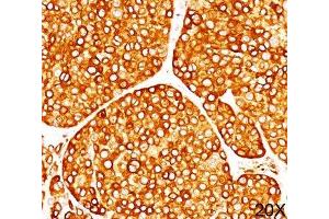 IHC staining of melanoma tissue (20X) with Tyrosinase antibody (T311).