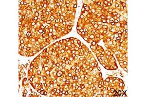 IHC staining of melanoma tissue (20X) with Tyrosinase antibody (T311). (TYR anticorps)