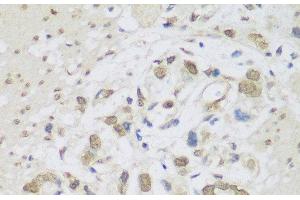 Immunohistochemistry of paraffin-embedded Human gastric cancer using DHX38 Polyclonal Antibody at dilution of 1:150 (40x lens). (DHX38 anticorps)