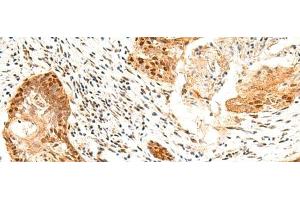 Immunohistochemistry of paraffin-embedded Human esophagus cancer tissue using SETMAR Polyclonal Antibody at dilution of 1:60(x200) (SETMAR anticorps)