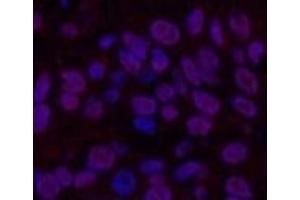 Immunofluorescence analysis of Human lung cancer tissue using Transferrin Monoclonal Antibody at dilution of 1:200. (Transferrin anticorps)
