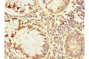 Immunohistochemistry of paraffin-embedded human colon cancer using ABIN7176726 at dilution of 1:100
