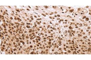 Immunohistochemistry of paraffin-embedded Human esophagus cancer using PARP1 Polyclonal Antibody at dilution of 1:40