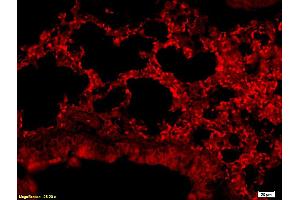 Formalin-fixed and paraffin embedded human colon carcinoma labeled with Anti-CD24 Polyclonal Antibody, Unconjugated (ABIN669681) at 1:200, followed by conjugation to the secondary antibody