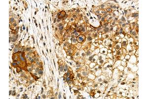 ABIN7093100 and ABIN7097254 at 1/100 staining Human ovarian cancer by IHC-P. (MLKL anticorps  (pSer347))