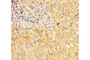 Immunohistochemistry of paraffin-embedded human liver cancer using ABIN7160703 at dilution of 1:100 (PGLYRP2 anticorps  (AA 22-576))