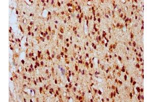 IHC image of ABIN7145109 diluted at 1:700 and staining in paraffin-embedded human glioma performed on a Leica BondTM system. (ATG16L2 anticorps  (AA 262-348))