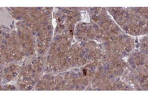 ABIN6273976 at 1/100 staining Human liver cancer tissue by IHC-P. (OR2A2 anticorps  (Internal Region))