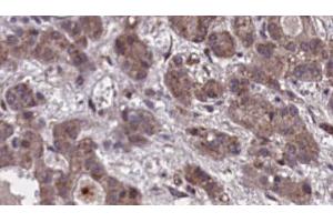 ABIN6273860 at 1/100 staining Human liver cancer tissue by IHC-P. (GPR20 anticorps  (C-Term))