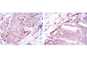 Immunohistochemical analysis of paraffin-embedded kidney cancer tissues (left) and stomach cancer tissues (right) using BMPR2 mouse mAb with DAB staining. (BMPR2 anticorps)