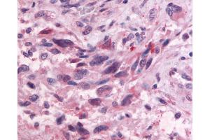 Anti-GPR83 antibody IHC of human Brain, Glioblastoma.