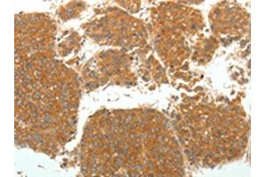 The image on the left is immunohistochemistry of paraffin-embedded Human liver cancer tissue using ABIN7131067(SIRT4 Antibody) at dilution 1/25. (SIRT4 anticorps)