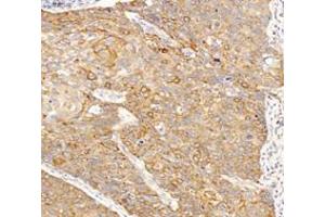 Immunohistochemistry analysis of paraffin-embedded humanes ophagus cancer using INSR (ABIN7074298) at dilution of 1: 6000