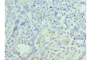 Immunohistochemistry of paraffin-embedded human lung cancer using ABIN7143847 at dilution of 1:100 (ACTR1A anticorps  (AA 187-376))