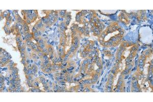Immunohistochemistry of paraffin-embedded Human thyroid cancer tissue using MUC15 Polyclonal Antibody at dilution 1:50 (MUC15 anticorps)