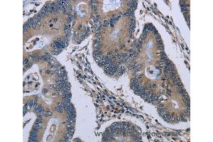 Immunohistochemistry of Human thyroid cancer using GJC2 Polyclonal Antibody at dilution of 1:40 (GJC2 anticorps)
