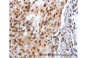 Immunohistochemistry of Human cervical cancer using MUTYH Polyclonal Antibody at dilution of 1:25 (MUTYH anticorps)